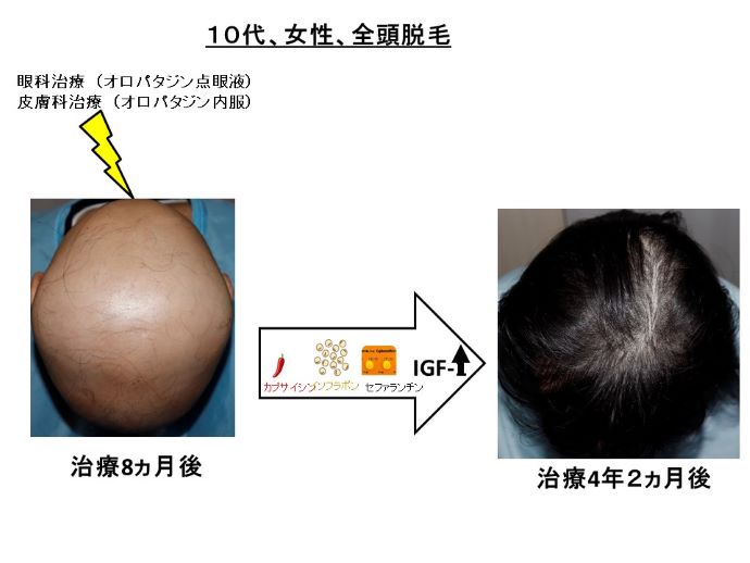 円形脱毛症　病院